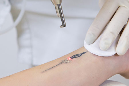 How to Remove Tattoos - New Look Laser College